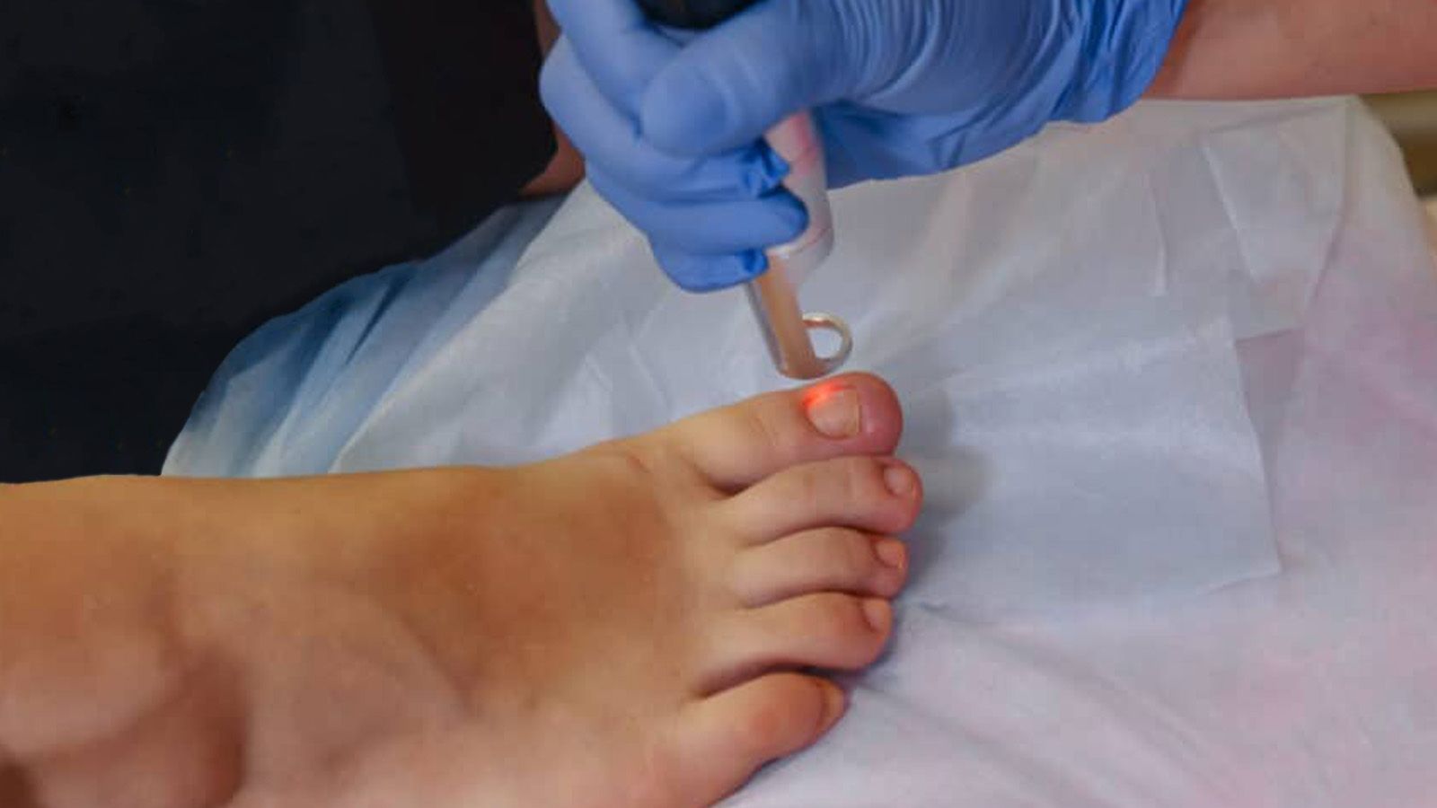 Kalknagel Schimmelnagel laseren voor mannen bij Bodyland